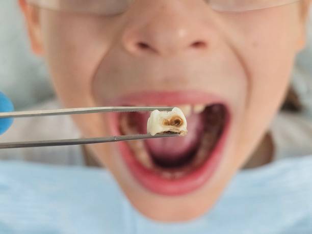 Best Emergency Dental Care for Broken or Chipped Teeth in Valle Vista, CA